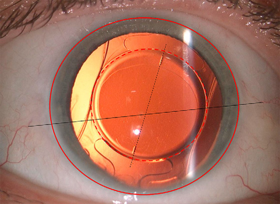 An image of a retro-illuminated toric intraocular lens (TIOL)